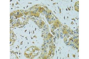 Immunohistochemistry of paraffin-embedded Human breast cancer using MTCH1 Polyclonal Antibody at dilution of 1:100 (40x lens). (MTCH1 antibody)