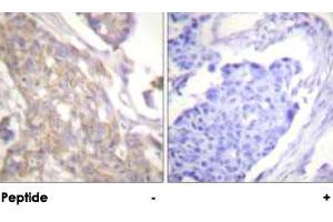 Immunohistochemical analysis of paraffin-embedded human breast carcinoma tissue using CSK polyclonal antibody . (CSK antibody)