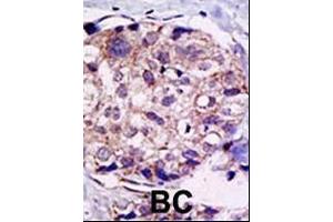 Formalin-fixed and paraffin-embedded human cancer tissue reacted with the primary antibody, which was peroxidase-conjugated to the secondary antibody, followed by DAB staining. (USP2 antibody  (C-Term))