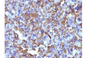 Formalin-fixed, paraffin-embedded human Histiocytoma stained with Macrophage Monoclonal Antibody (D11). (Macrophage / Histiocytoma Marker antibody)