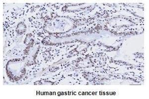 Paraffin embedded sections of human gastric canitrocelluloseer tissue were initrocelluloseubated with anti-human kLF4 (1:50) for 2 hours at room temperature. (KLF4 antibody  (AA 1-170))