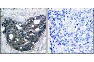 Immunohistochemistry analysis of paraffin-embedded human breast carcinoma tissue, using p56 Dok-2 (Ab-299) Antibody. (DOK2 antibody  (AA 266-315))