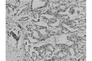 Immunohistochemical staining of paraffin-embedded human breast carcinoma tissue reacted with Acetyl lysine monoclonal antibody  at 1:200-1:500 dilution. (Acetylated Lysine antibody  (acetylated))