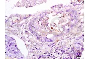 Formalin-fixed and paraffin embedded human lung cancer tissue labeled with Anti-RAP1A Polyclonal Antibody, Unconjugated (ABIN687472) at 1:200 followed by conjugation to the secondary antibody, (SP-0023), and DAB staining (RAP1A antibody  (AA 101-184))