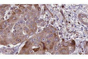 ABIN6276575 at 1/100 staining Human liver cancer tissue by IHC-P. (CAPNL1 antibody  (N-Term))