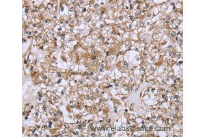 Immunohistochemistry of Human prostate cancer using FCAR Polyclonal Antibody at dilution of 1:20 (FCAR antibody)