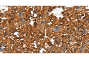 Immunohistochemistry of paraffin-embedded Human thyroid cancer using CTBP1 Polyclonal Antibody at dilution of 1:40 (CTBP1 antibody)