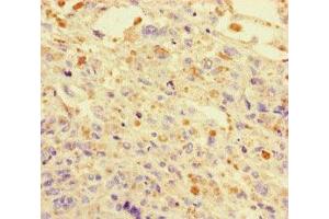 Immunohistochemistry of paraffin-embedded human melanoma using ABIN7150550 at dilution of 1:100 (DNAJC3 antibody  (AA 277-496))