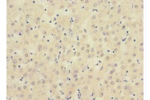 Immunohistochemistry of paraffin-embedded human liver cancer using ABIN7169723 at dilution of 1:100 (SIGIRR antibody  (AA 1-120))