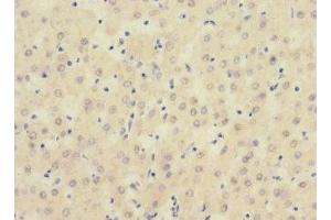 Immunohistochemistry of paraffin-embedded human liver cancer using ABIN7169723 at dilution of 1:100 (SIGIRR antibody  (AA 1-120))