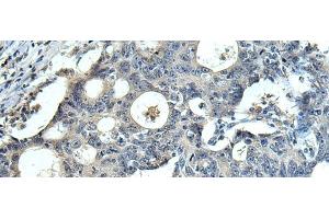 Immunohistochemistry of paraffin-embedded Human colorectal cancer tissue using FCRLA Polyclonal Antibody at dilution of 1:90(x200)