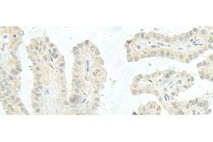 Immunohistochemistry of paraffin-embedded Human thyroid cancer tissue using MIEN1 Polyclonal Antibody at dilution of 1:45(x200) (C17orf37 antibody)
