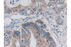 DAB staining on IHC-P; Samples: Human Colorectal cancer Tissue (Desmoplakin antibody  (AA 2609-2822))