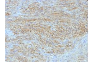 Formalin-fixed, paraffin-embedded human GIST stained with DOG1 Monoclonal Antibody (SPM580).