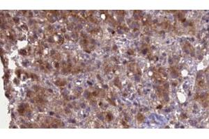 ABIN6276969 at 1/100 staining Human liver cancer tissue by IHC-P. (GRIK2 antibody  (Internal Region))