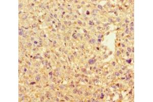 Immunohistochemistry of paraffin-embedded human melanoma using ABIN7150029 at dilution of 1:100 (DAAM2 antibody  (AA 1-101))
