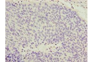 Immunohistochemistry of paraffin-embedded human cervical cancer using ABIN7148022 at dilution of 1:100 (COPZ1 antibody  (AA 1-177))