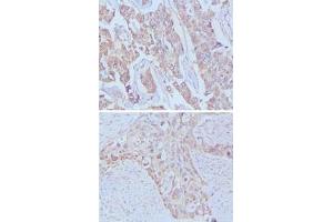 Immunohistochemical analysis of paraffin-embedded human breast cancer (upper) and lung cancer (bottom) tissues using EGF monoclonal antibody, clone 9D7F11  .