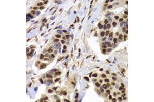 Immunohistochemistry of paraffin-embedded human breast cancer using XRCC5 Antibody. (XRCC5 antibody  (AA 543-732))