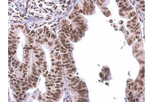 IHC-P Image COBRA1 antibody detects COBRA1 protein at nucleus on human gastric cancer by immunohistochemical analysis. (COBRA1 antibody  (Center))