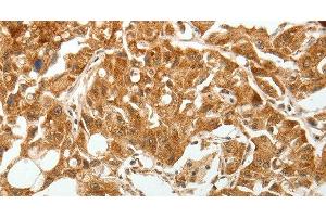 Immunohistochemistry of paraffin-embedded Human lung cancer tissue using TGF β Receptor I Polyclonal Antibody at dilution 1:60 (TGFBR1 antibody)