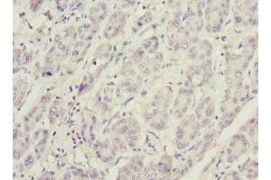 Immunohistochemistry of paraffin-embedded human liver cancer using ABIN7163403 at dilution of 1:100 (PHKG2 antibody  (AA 237-406))