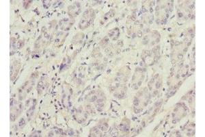 Immunohistochemistry of paraffin-embedded human liver cancer using ABIN7163403 at dilution of 1:100 (PHKG2 antibody  (AA 237-406))