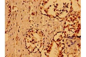 Immunohistochemistry of paraffin-embedded human breast cancer using ABIN7161807 at dilution of 1:100 (NUMA1 antibody  (AA 627-870))