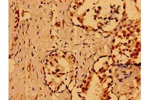 Immunohistochemistry of paraffin-embedded human breast cancer using ABIN7161807 at dilution of 1:100
