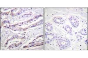 Immunohistochemistry analysis of paraffin-embedded human breast carcinoma, using p70 S6 Kinase (Phospho-Thr389) Antibody. (RPS6KB1 antibody  (pThr412))