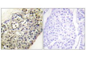 Immunohistochemistry analysis of paraffin-embedded human breast carcinoma tissue, using LATH antibody. (LATH antibody  (Internal Region))