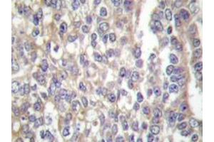 Immunohistochemistry  analyzes of Shc antibody in paraffin-embedded human breast carcinoma tissue. (SHC1 antibody)