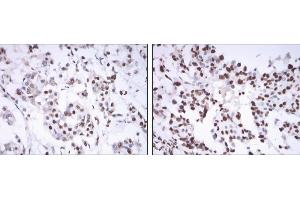 Immunohistochemical analysis of paraffin-embedded mammary cancer tissues using ESR1 mouse mAb with DAB staining. (Estrogen Receptor alpha antibody)