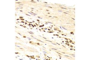 Immunohistochemistry of paraffin-embedded human gastric cancer using PRPF3 Antibody (ABIN1876670) at dilution of 1:100 (40x lens). (PRPF3 antibody)
