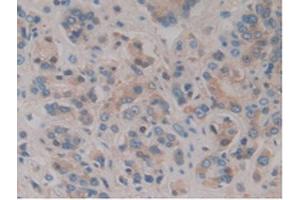 IHC-P analysis of Human Prostate Gland Cancer Tissue, with DAB staining. (HPR antibody  (AA 70-332))