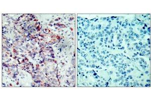 Immunohistochemical analysis of paraffin-embedded human breast carcinoma tissue, using SEK1/MKK4 (phospho-Ser80) antibody (E011177). (MAP2K4 antibody  (pSer80))