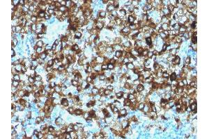Formalin-fixed, paraffin-embedded human Melanoma stained with gp100 Rabbit Polyclonal Antibody.