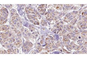 ABIN6278488 at 1/100 staining Human Melanoma tissue by IHC-P.