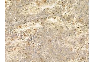 ABIN6258772 and ABIN6274897 at 1/100 staining human melanoma by IHC-P. (EPB41L2 antibody  (Internal Region))