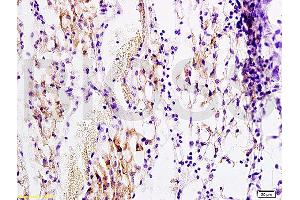 Formalin-fixed and paraffin embedded rat transplant lymphoma labeled with Anti-PDGF-B Polyclonal Antibody, Unconjugated (ABIN725990) at 1:200 followed by conjugation to the secondary antibody and DAB staining (PDGFB antibody  (AA 155-210))