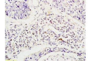 Formalin-fixed and human esophageal cancer tissue labeled with Anti-Phospho-CD19(Tyr531) Polyclonal Antibody, Unconjugated  at 1:200 followed by conjugation to the secondary antibody and DAB staining (CD19 antibody  (pTyr531))