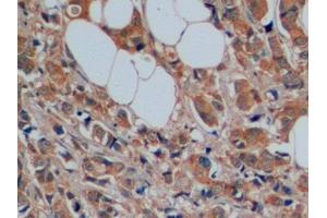 Detection of SERT in Human Breast cancer Tissue using Polyclonal Antibody to Serotonin Transporter (SERT) (SLC6A4 antibody  (AA 181-252))