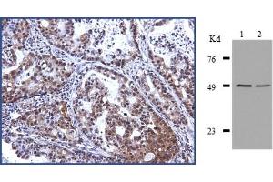 CB-l at 1/1000 dilution staining EAP-Il Of human lung adenocarcinoma. (TDP2 antibody)
