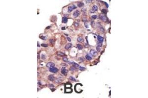 Formalin-fixed and paraffin-embedded human cancer tissue reacted with the primary antibody, which was peroxidase-conjugated to the secondary antibody, followed by DAB staining. (UBE2L3 antibody  (C-Term))