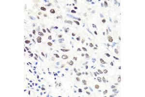 Immunohistochemistry of paraffin-embedded human lung cancer using CBX1 antibody at dilution of 1:100 (x40 lens). (CBX1 antibody)