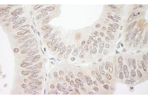 Immunohistochemistry (IHC) image for anti-Denticleless E3 Ubiquitin Protein Ligase Homolog (DTL) (AA 375-425) antibody (ABIN7454381)