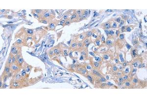 Immunohistochemistry of paraffin-embedded Human breast cancer tissue using IBSP Polyclonal Antibody at dilution of 1:50 (IBSP antibody)
