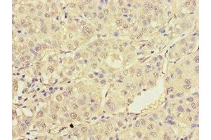 Immunohistochemistry of paraffin-embedded human liver cancer using ABIN7172232 at dilution of 1:100 (TRAF2 antibody  (AA 147-281))