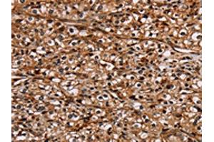 The image on the left is immunohistochemistry of paraffin-embedded Human prostate cancer tissue using ABIN7130441(NOC2L Antibody) at dilution 1/20, on the right is treated with fusion protein. (NOC2L antibody)