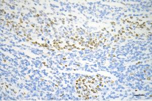 Immunohistochemistry was performed on paraffin-embedded human sigmoid colon carcinoma using MCM6 antibody (ABIN7799421), 1:200). (Recombinant MCM6 antibody)